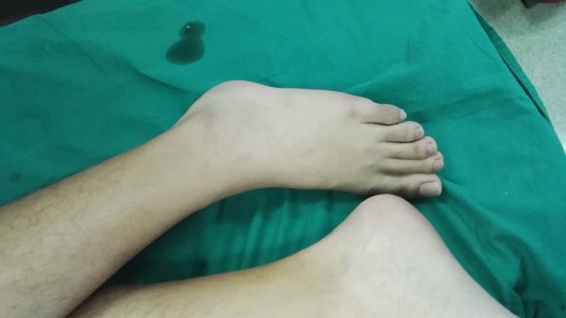 检查患者足部,可见患者存在莫顿足(相对较长的第二跖骨和较短的第一