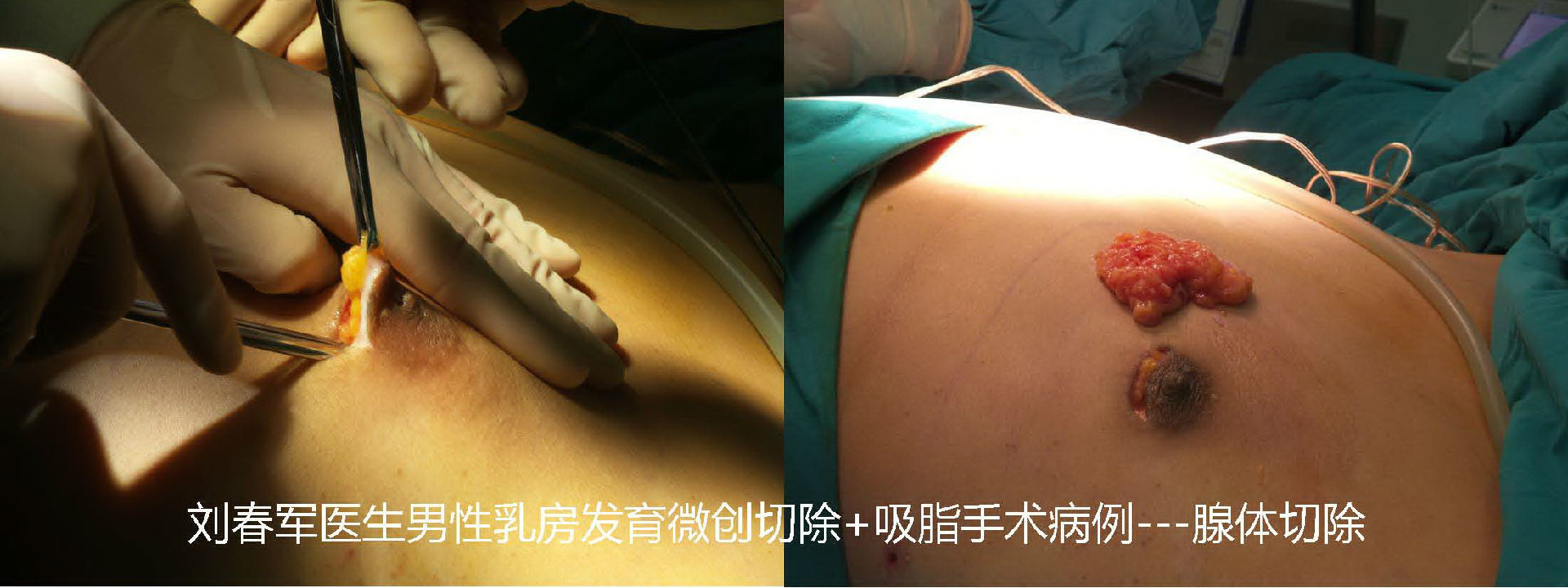 男性乳腺增生手术图片图片