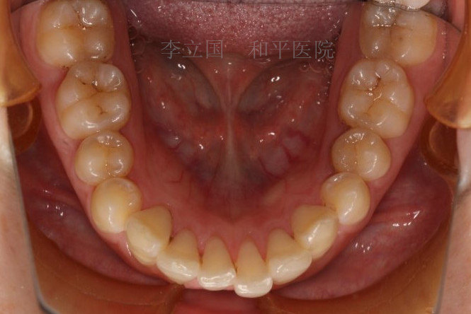 龅牙妹的华丽变身_牙颌畸形_治疗方法_ - 好大夫在线