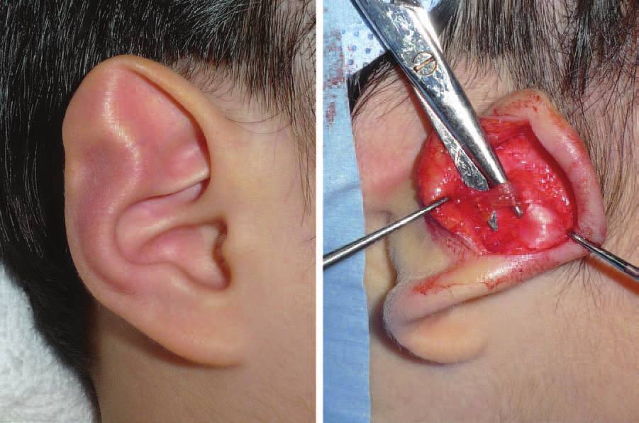 从耳周肌肉分布图解释杯状耳,招风耳,隐耳畸形如何修复_耳部整形_手术