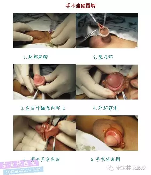 环切手术后发炎图片 搜狗图片搜索