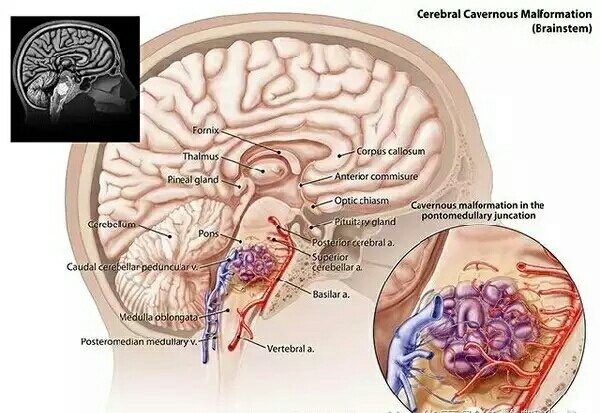 颅内的定时炸弹