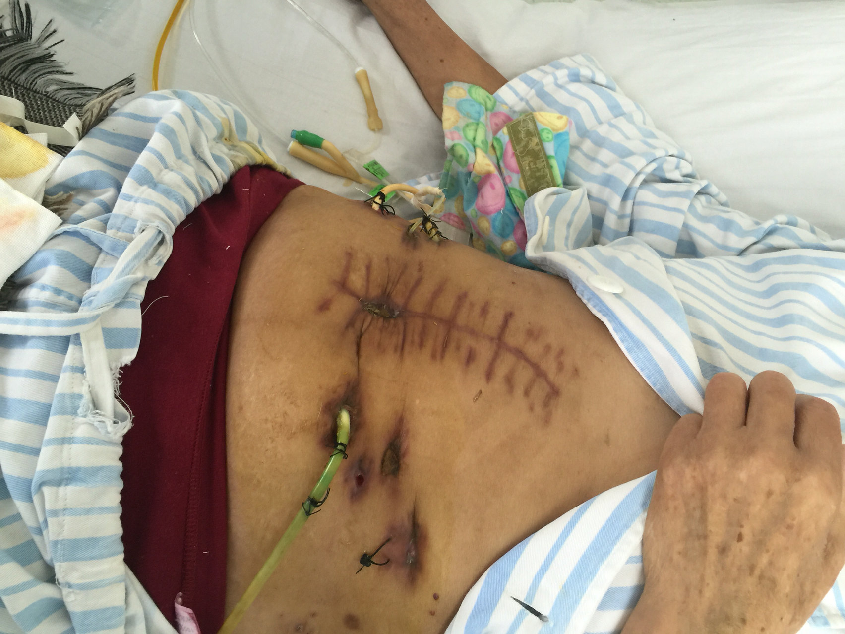 胰头癌切除后胰漏出血非计划性再手术新方式成功 - 好大夫在线