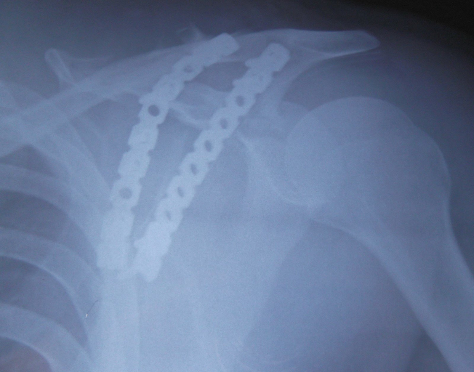 第二节 肩胛骨骨折-肩部损伤诊疗-医学