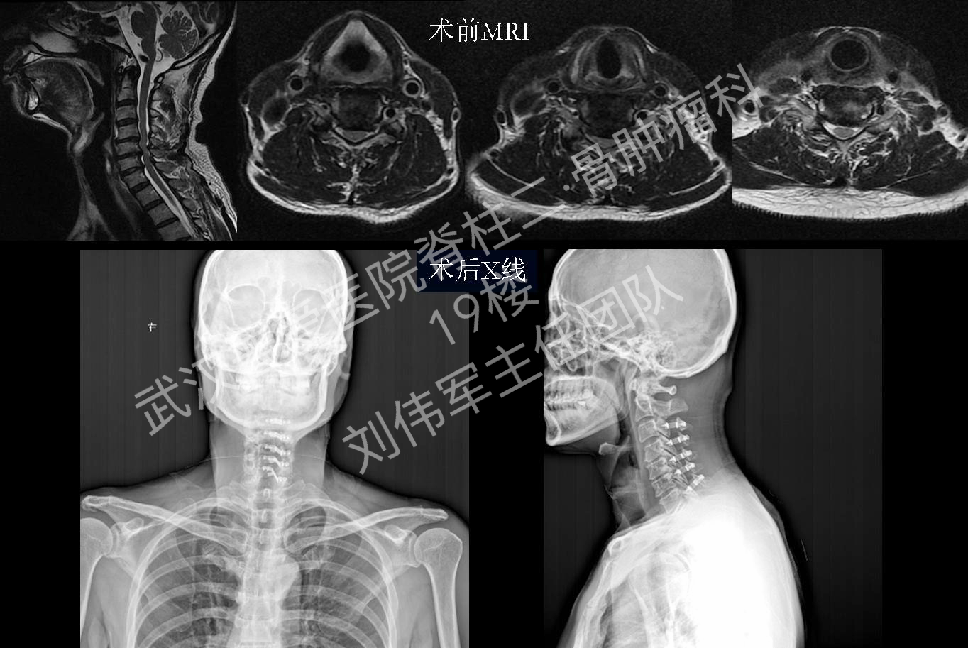 2016年刘主任团队典型病例:脊髓型颈椎病-后路
