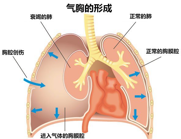 胸壁皮下气肿图片