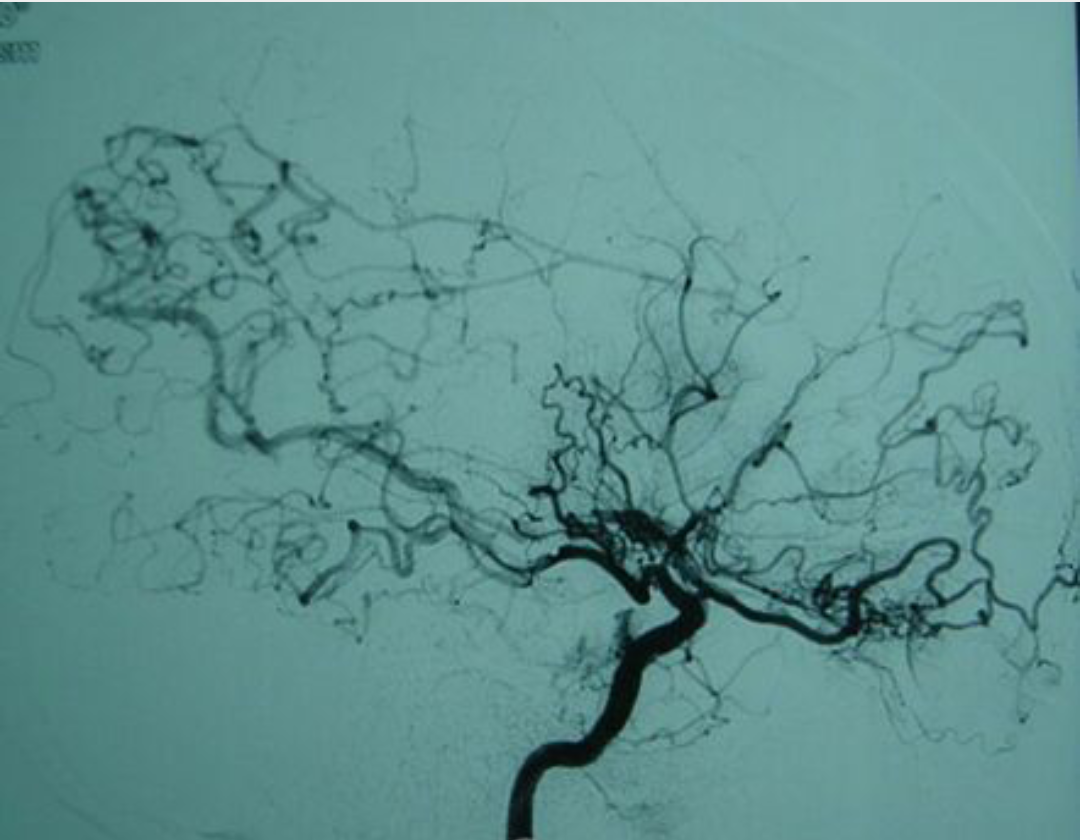 烟雾病科普 - 好大夫在线