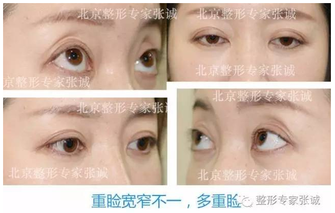 各种失败双眼皮的症状表现 修复方法及最佳时间 双眼皮手术 症状 病因 日常护理 治疗方法