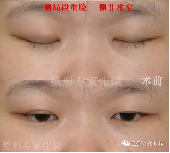 各种失败双眼皮的症状表现 修复方法及最佳时间 双眼皮手术 症状 病因 日常护理 治疗方法