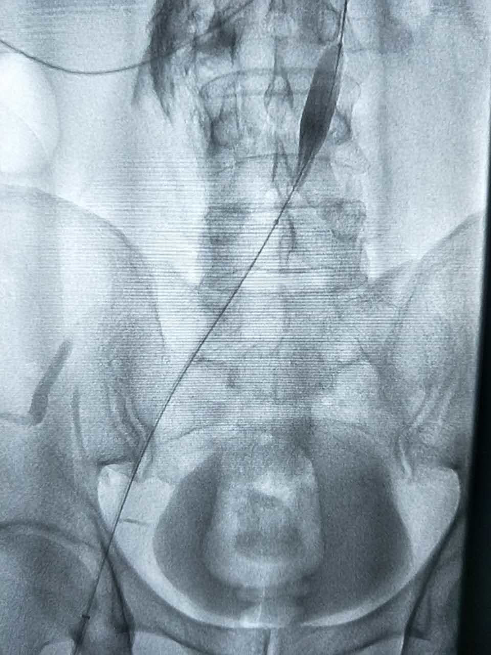 腿肿的原因分析