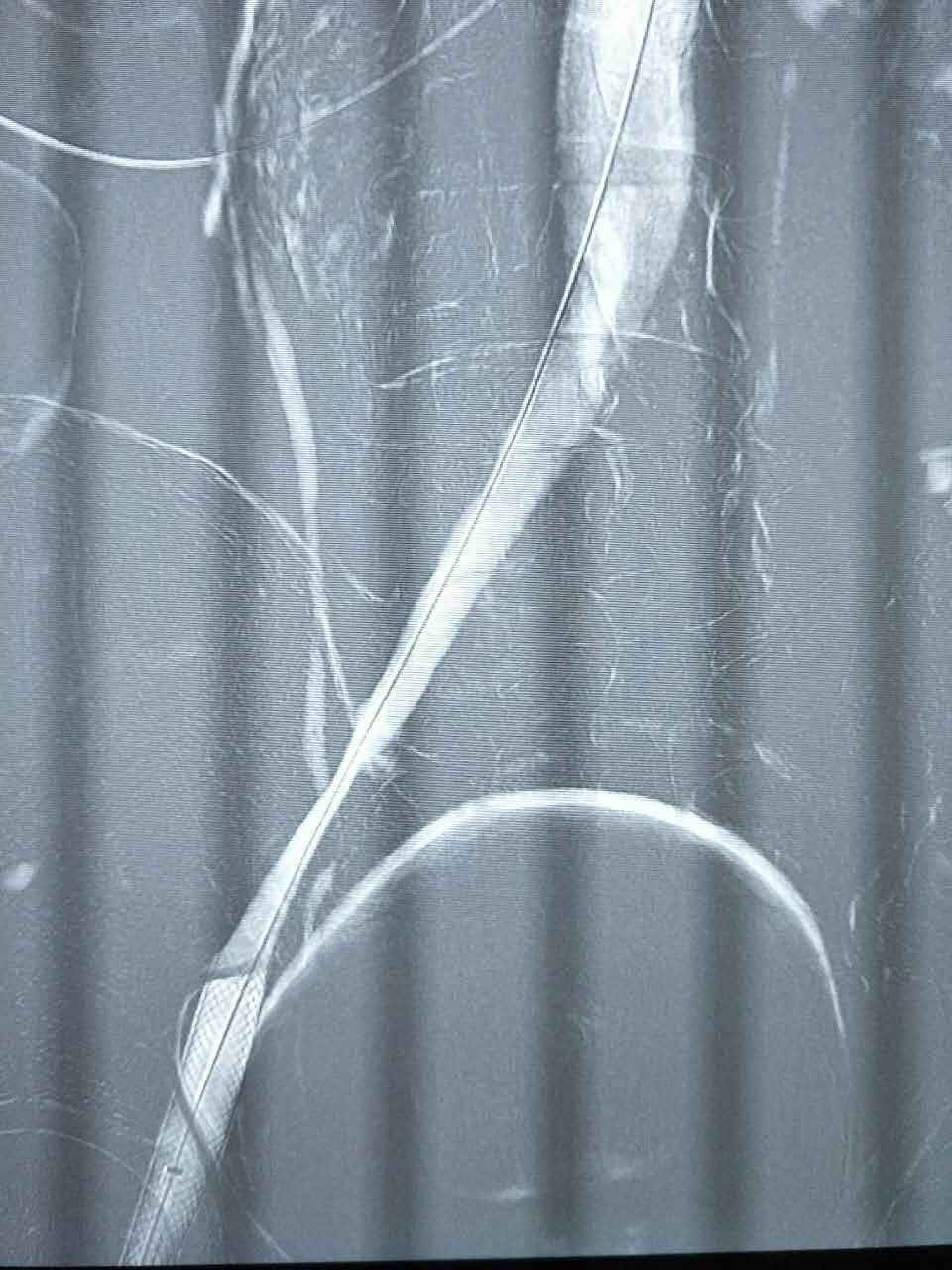 腿肿的原因分析