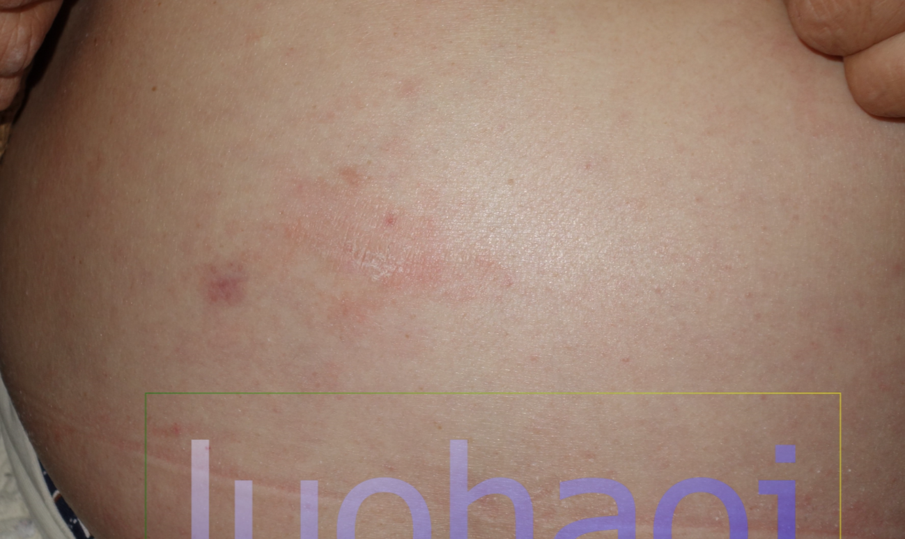 副银屑病采用中医辨证治疗取得满意效果