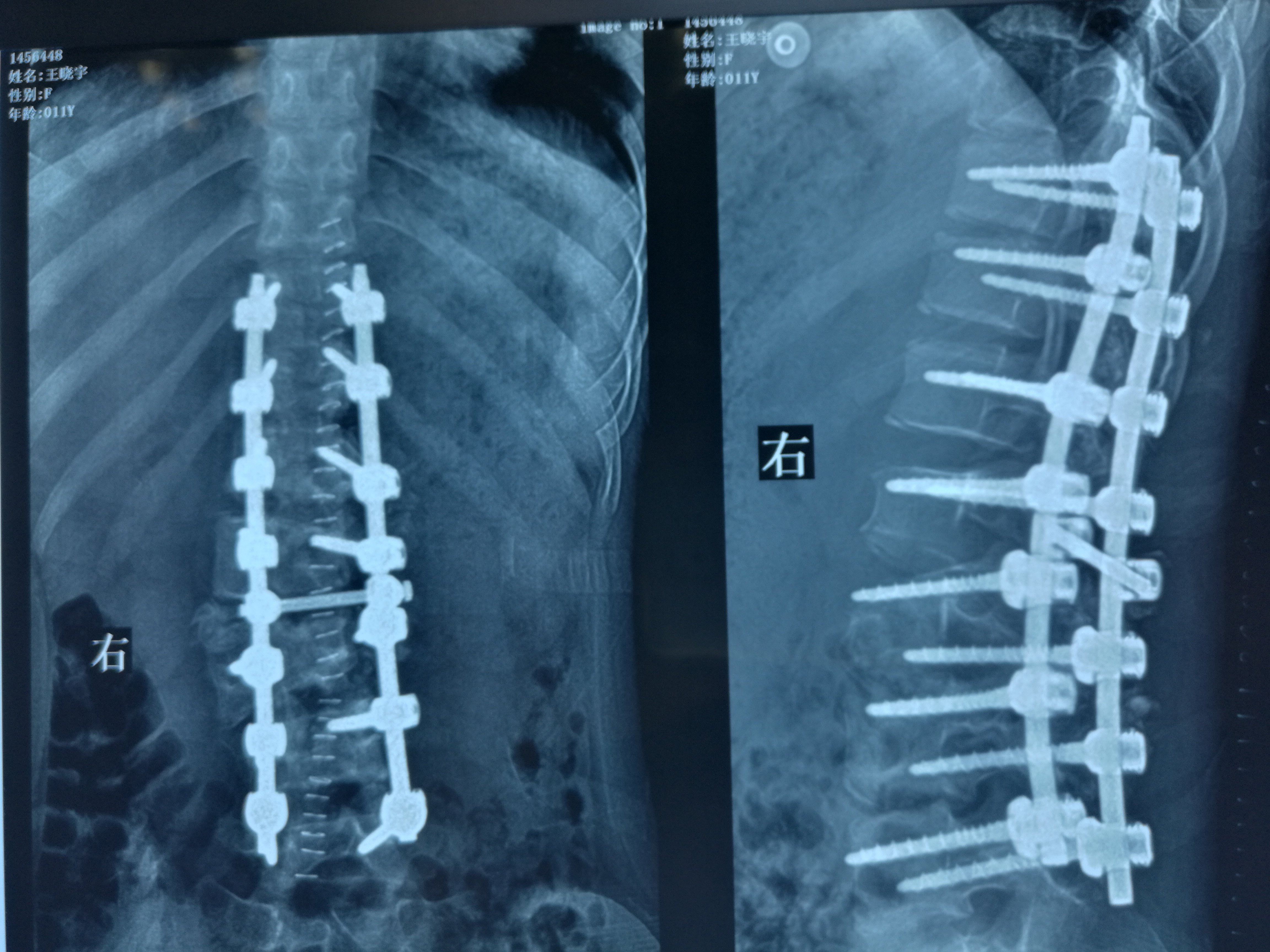 脊柱侧弯手术 利弊图片