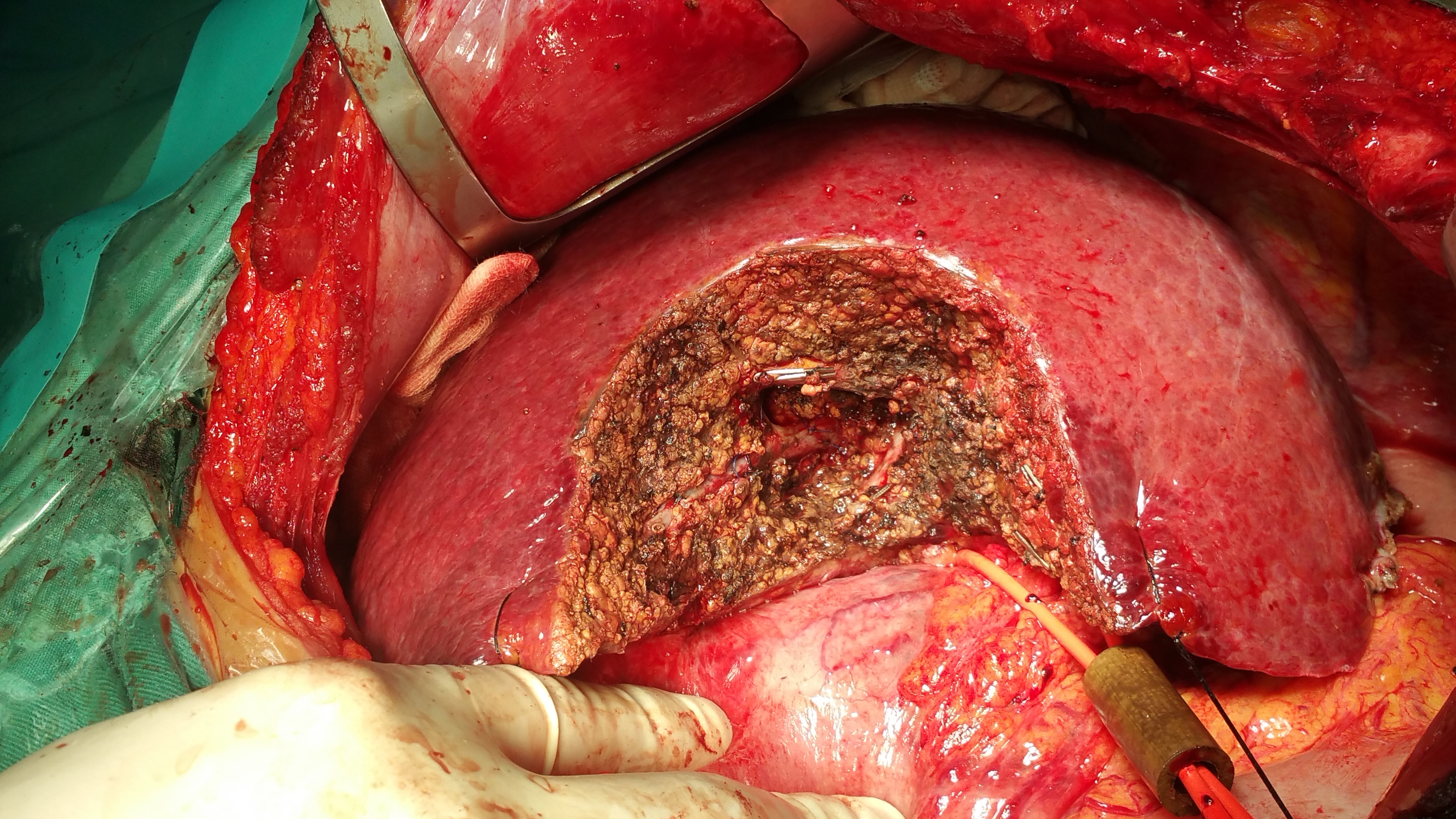 肝大血管丛中的肿瘤肝切除 - 好大夫在线