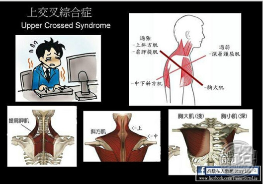 圆肩,驼背,头前引—上交叉综合症的肌动学基础及处理策略 - 好大夫