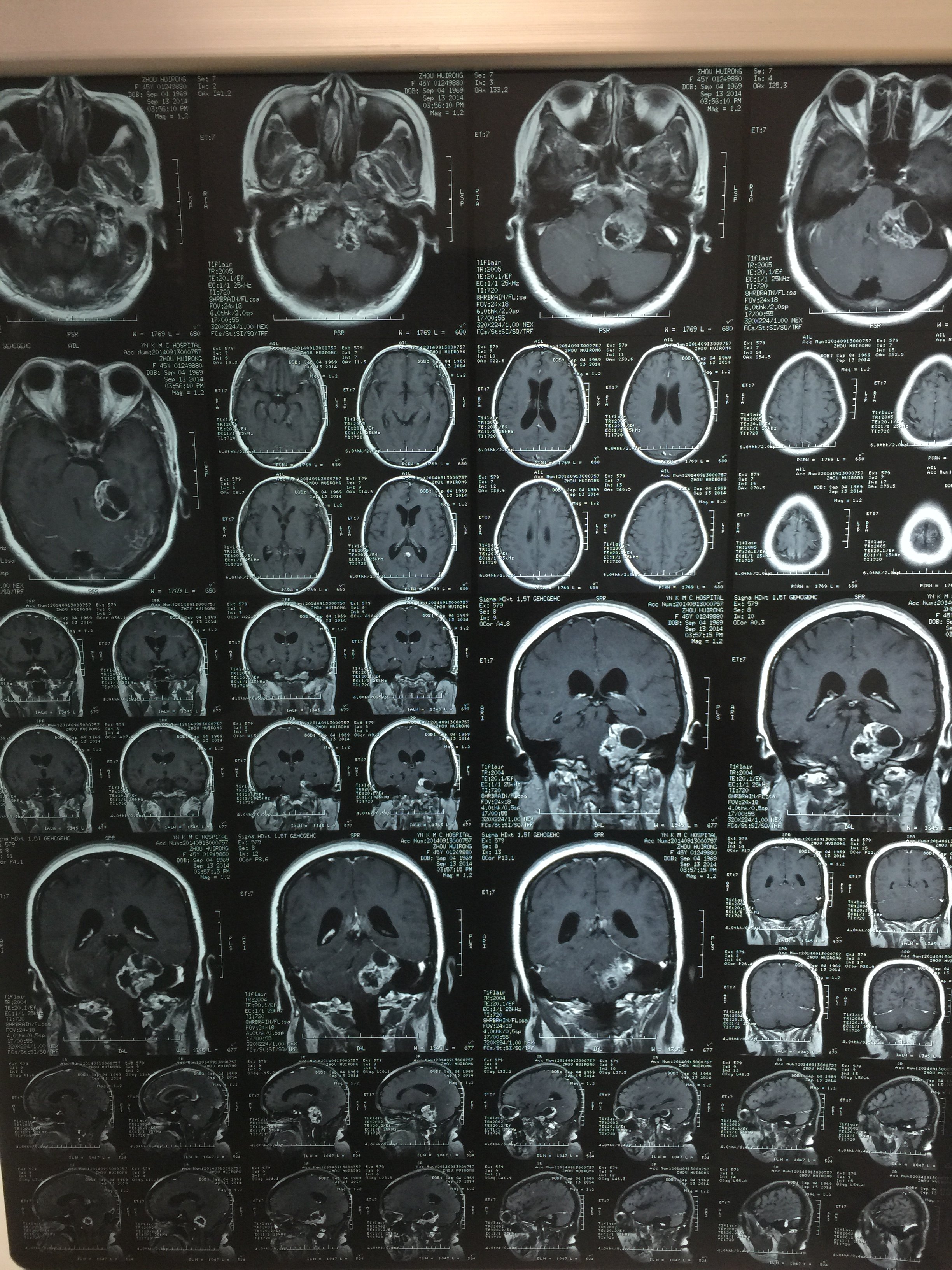 听神经瘤全切除2例,术后无面瘫 - 好大夫在线
