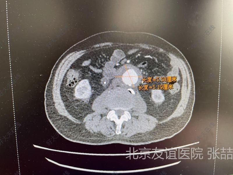 友谊医院穿刺预约-友谊医院甲状腺穿刺专家 