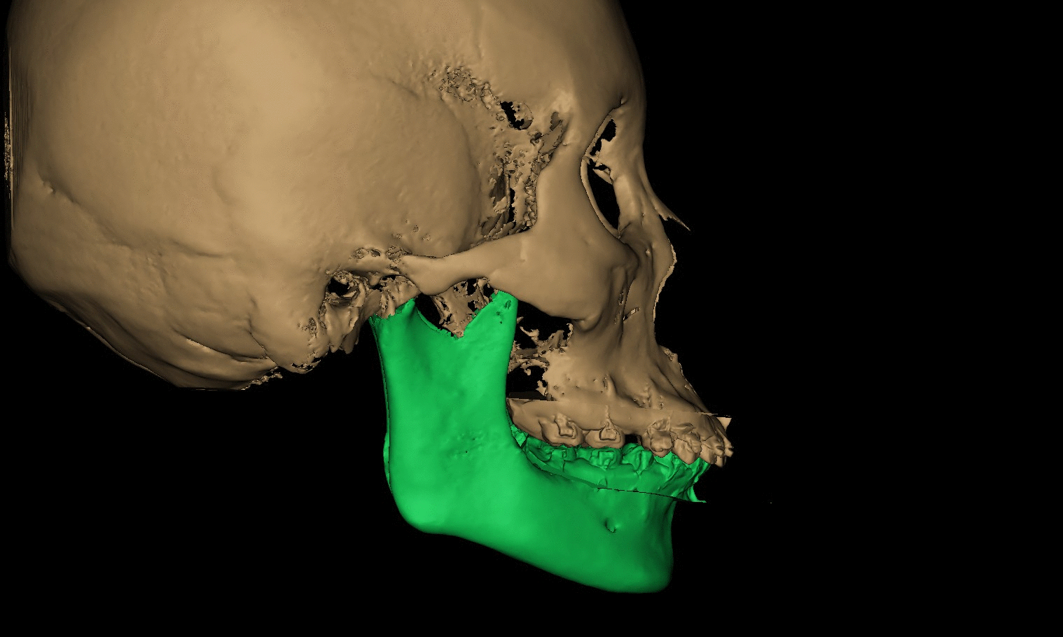 骨性ii类牙颌面畸形的正畸正颌联合治疗_牙颌畸形_牙颌畸形治疗方式