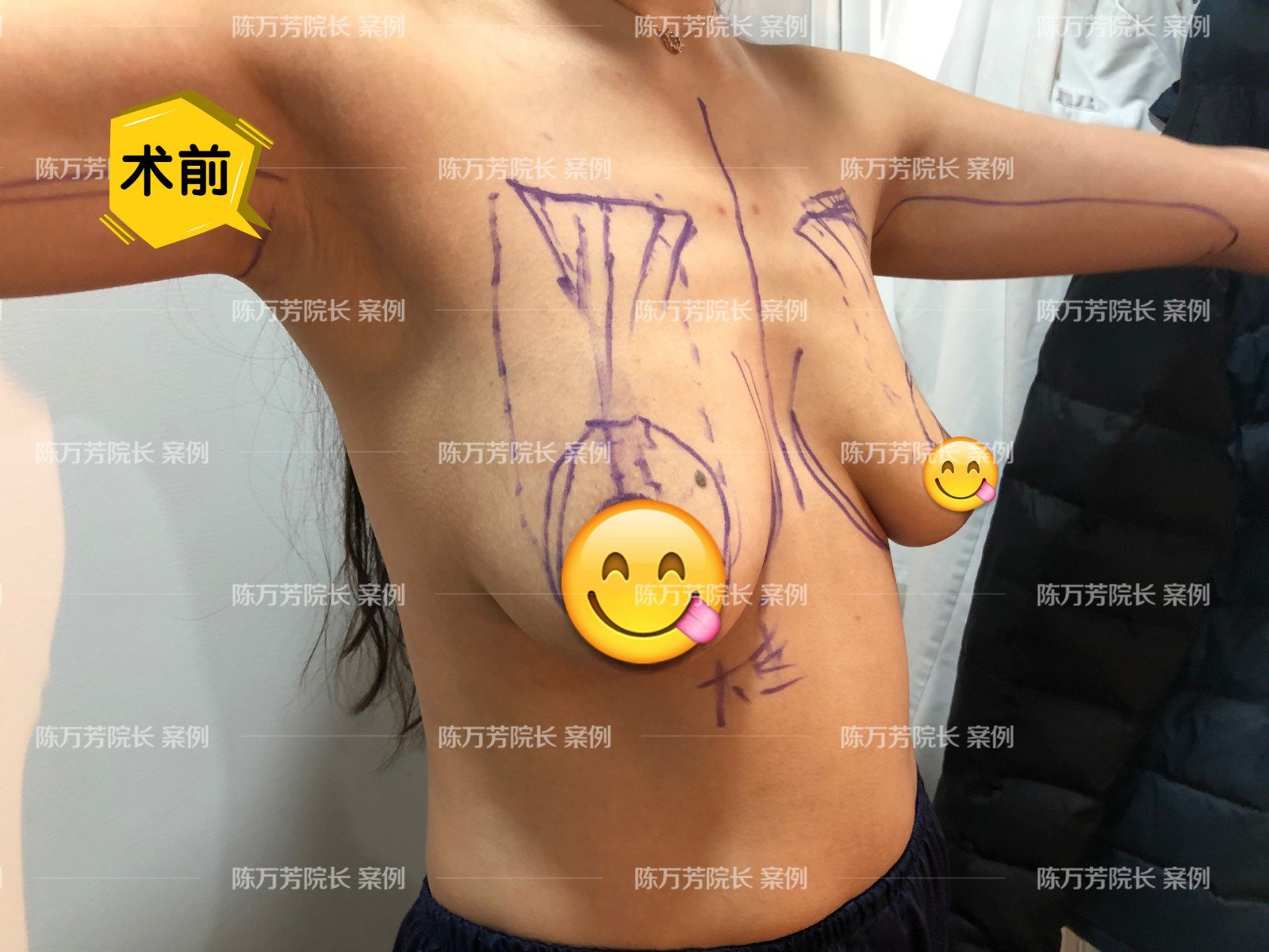 乳房下垂矫正真人案例分享 乳房下垂矫正术 乳房下垂矫正术治疗介绍 好大夫在线