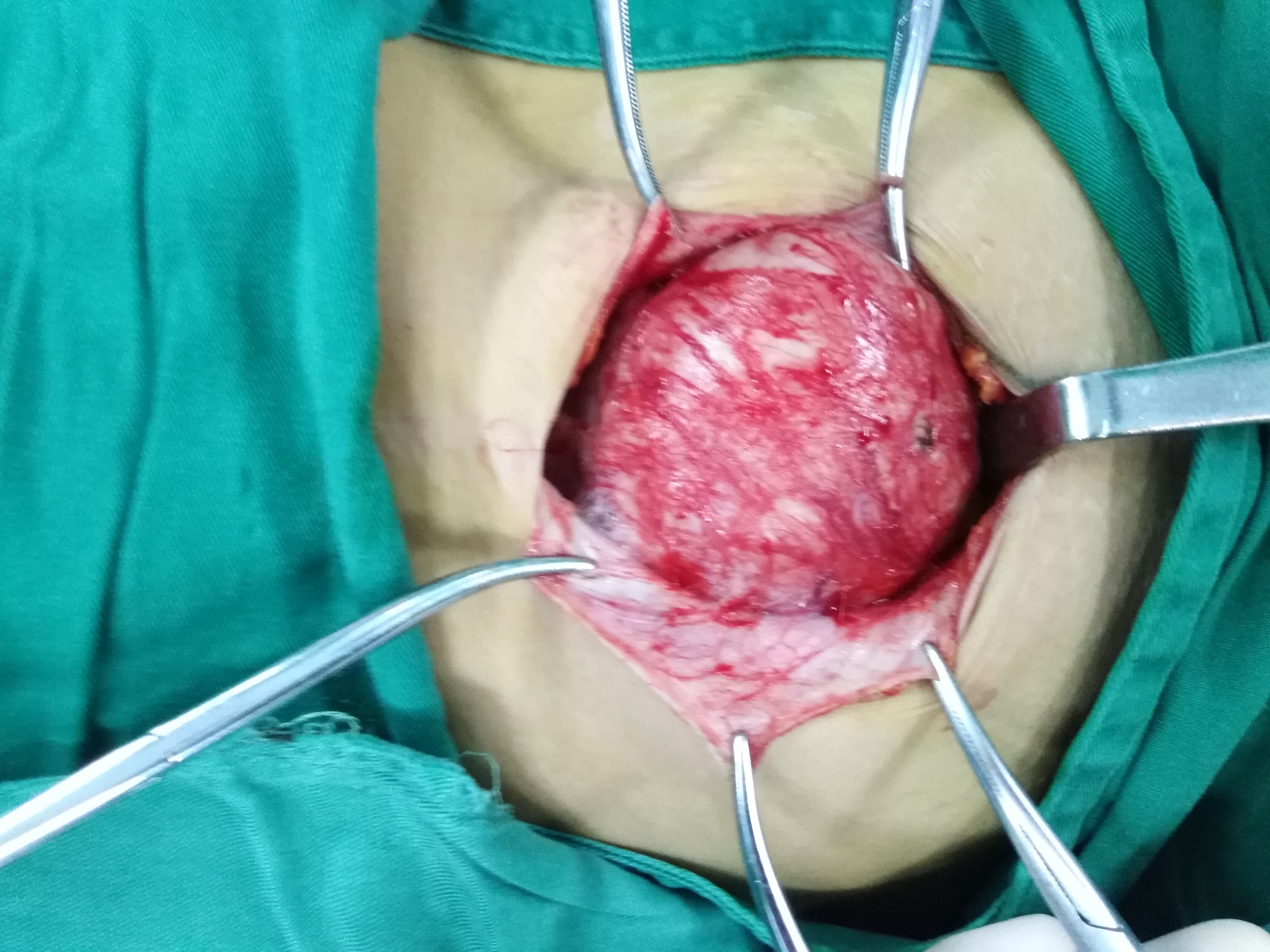 左下腹腹壁肿瘤完美切除 - 好大夫在线