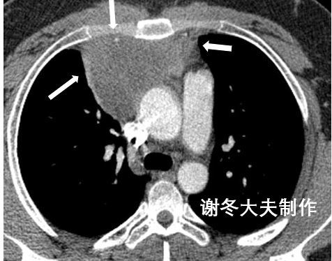 縱隔神經源性腫瘤是癌嗎嚴重嗎怎麼治療是否需要手術切除