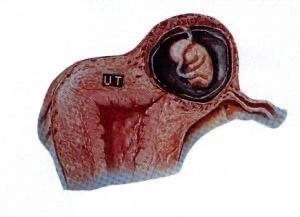 间质部妊娠图片