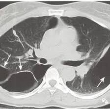 肺大疱及其治疗原则 肺大疱 介绍 治疗方式 好大夫在线 肺大疱及其治疗原则 肺大疱 介绍 治疗方式 好大夫在线
