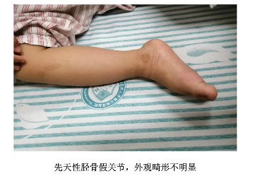 疾病,其特征为胫骨中下段节段性发育异常,无正常骨形成,伴随成角畸形