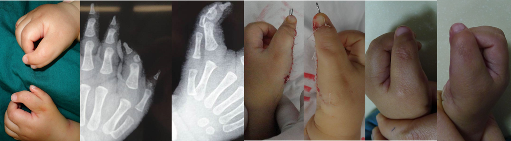 多指畸形概述(大量手术实例!)_多指畸形_介绍_治疗方式 - 好大夫在线