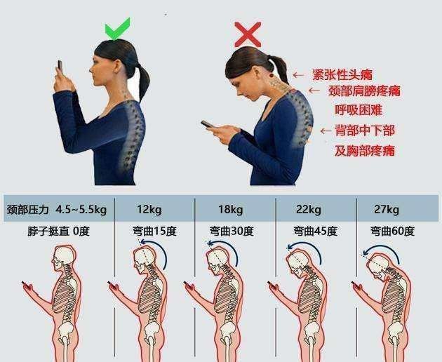 颈椎生理曲度变直并非完全不可逆