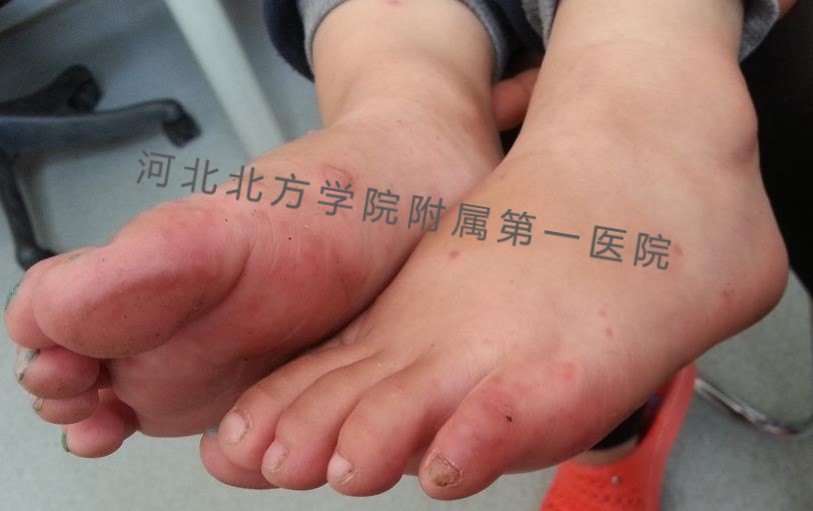 【手足口病】6,手足口病的临床图片_手足口病_手足口病症状表现 - 好