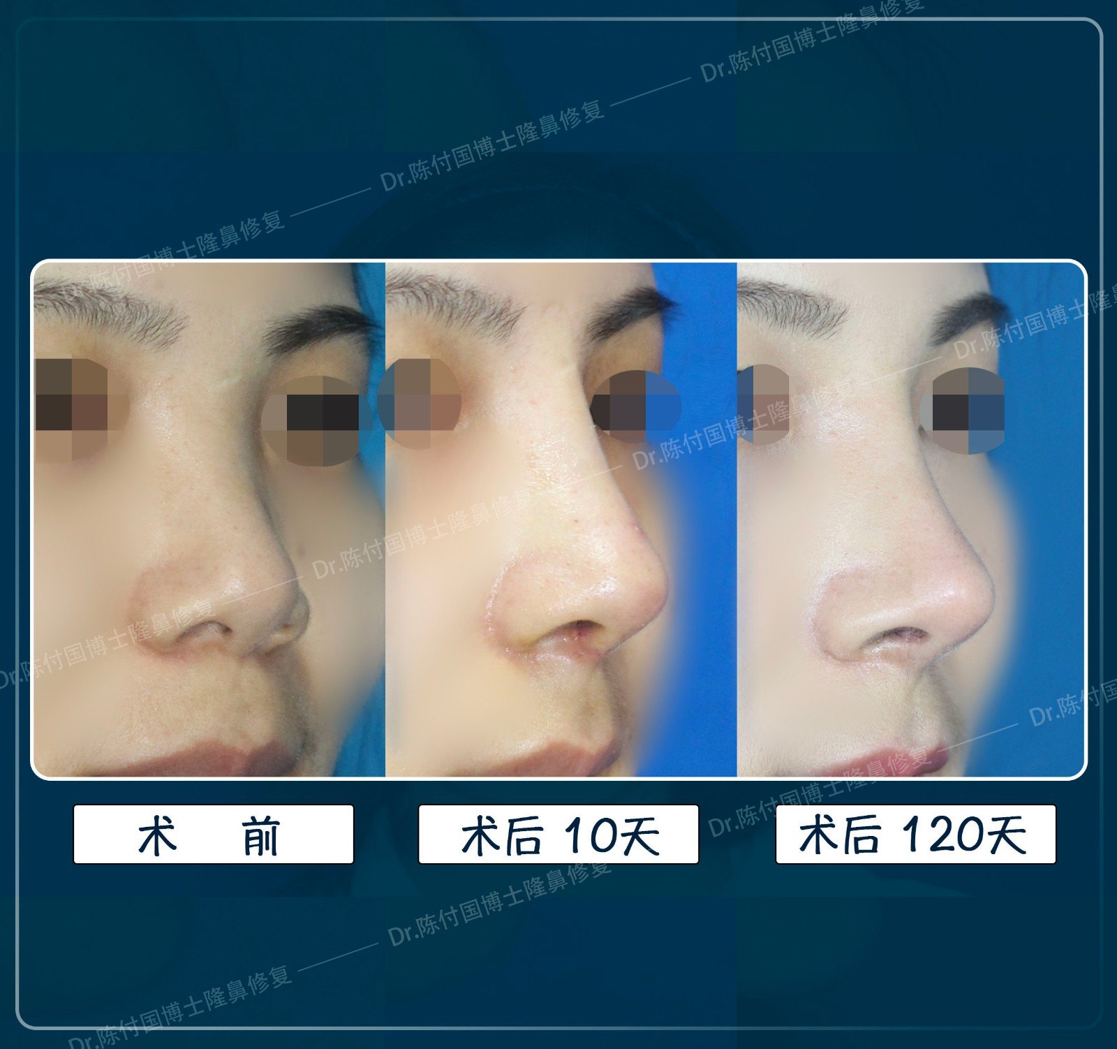 鼻综合术后恢复过程全记录 自然微翘鼻诞生的全过程 鼻部整形 好大夫在线 鼻综合术后恢复过程全记录 自然微翘鼻诞生的全过程 鼻部整形 好大夫在线