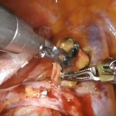 一步一步看懂机器人肺叶切除之-右肺下叶切除 - 好大夫在线