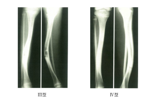 Ⅲ型:通常於脛骨中下1/3交界處發生先天性骨囊腫,脛骨向前彎曲可先於