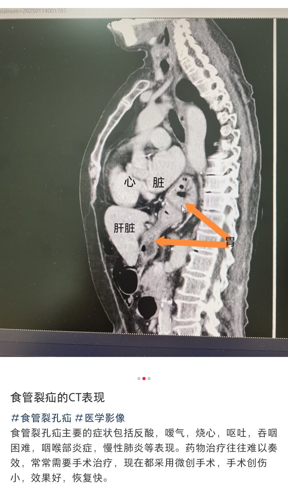 食管裂孔疝的ct表现