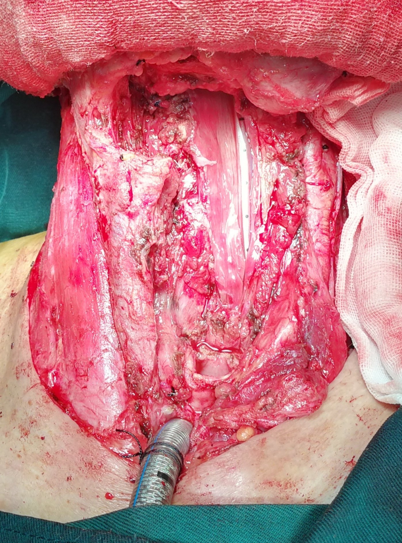 喉癌全喉切除并颈部淋巴结清扫术中的颈部解剖情况 