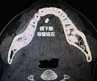 颌下腺囊肿图片ct图片图片