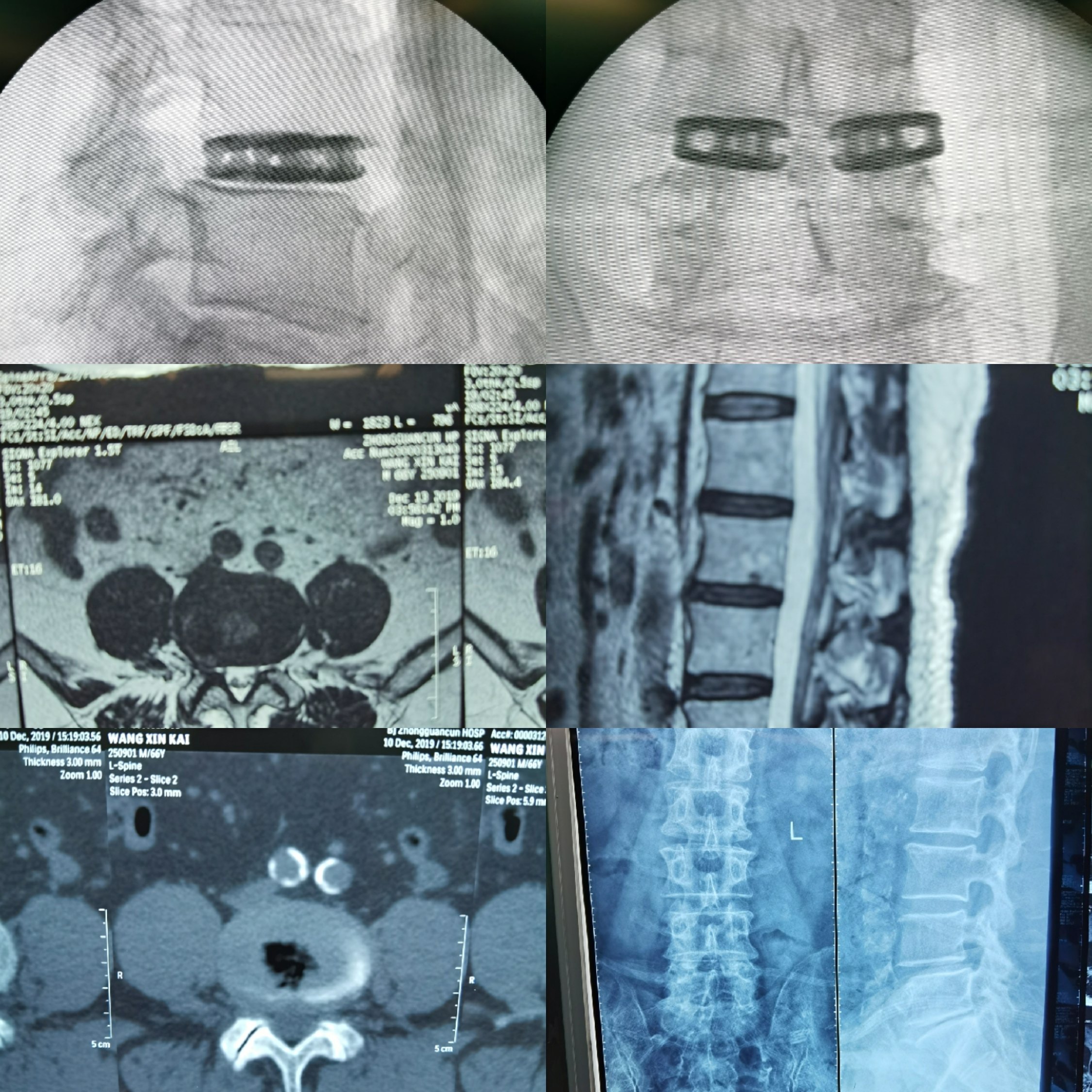 椎间孔镜技术下双枚cage腰椎间撑开融合术(wlif)病例2019.12.