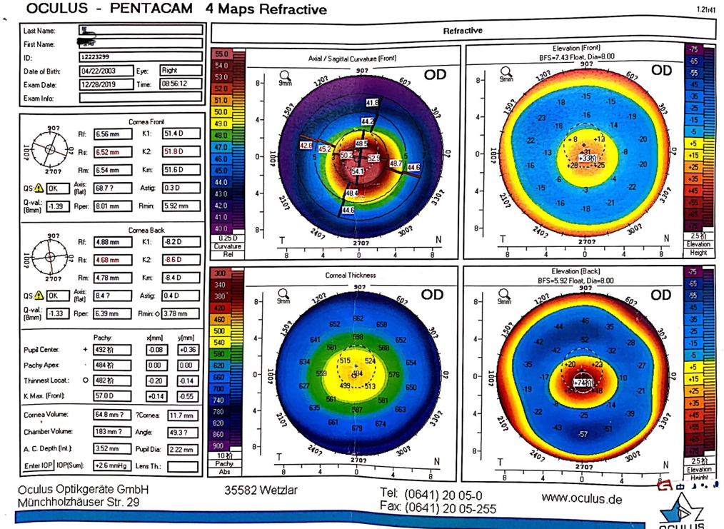 角膜地形图英文图片