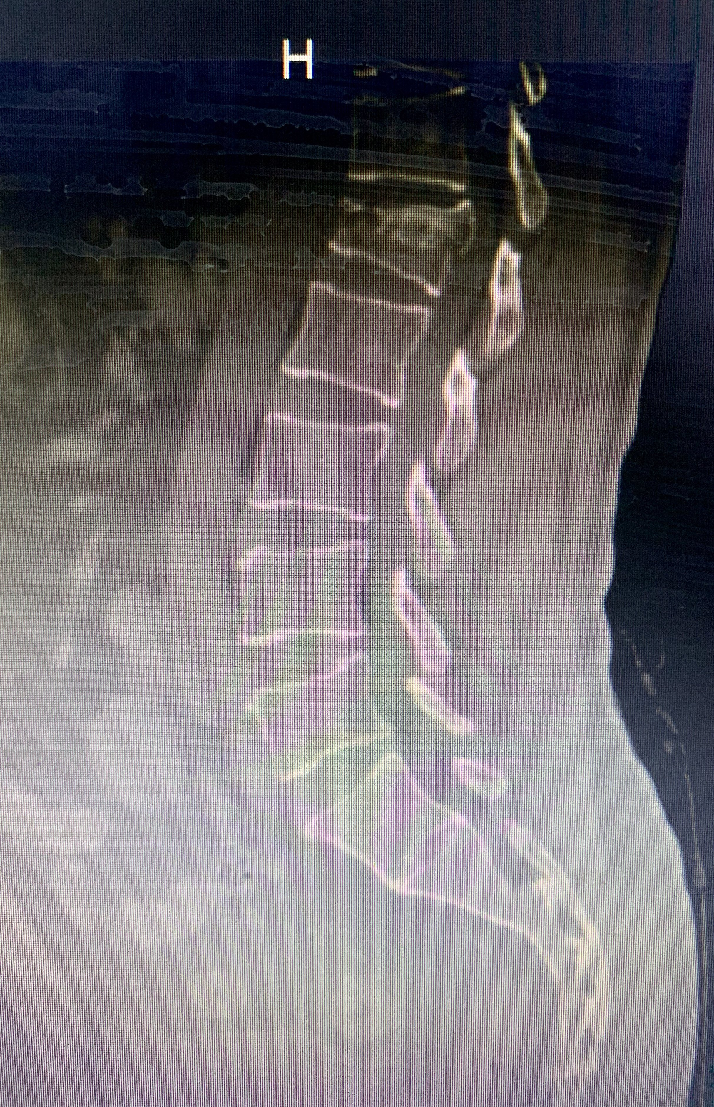 脊柱裂 显性图片