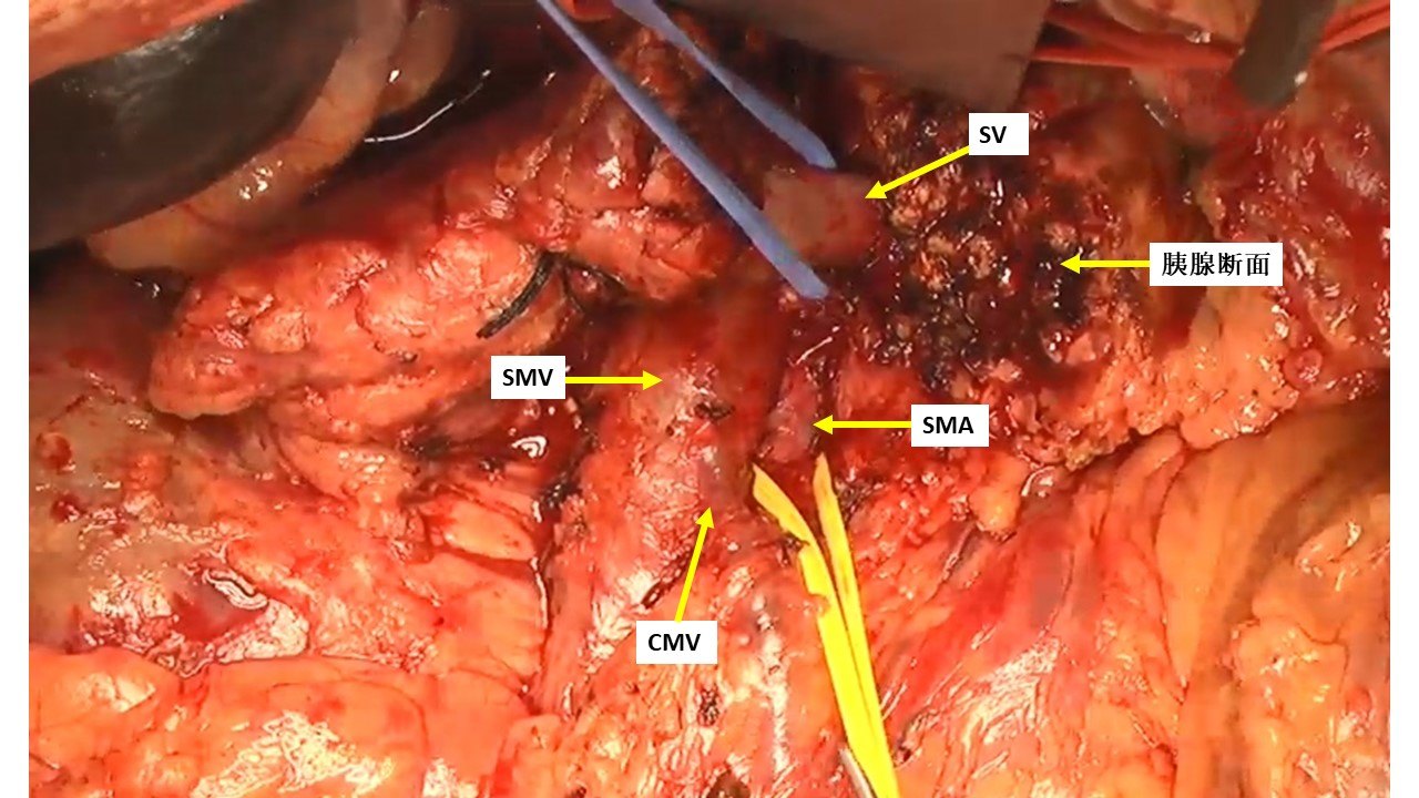 根治性胰十二指腸切除術治療壺腹周圍癌膽管遠端癌乳頭癌胰腺癌