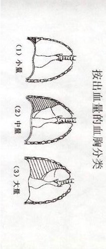 血胸及其治疗原则 血胸 血胸