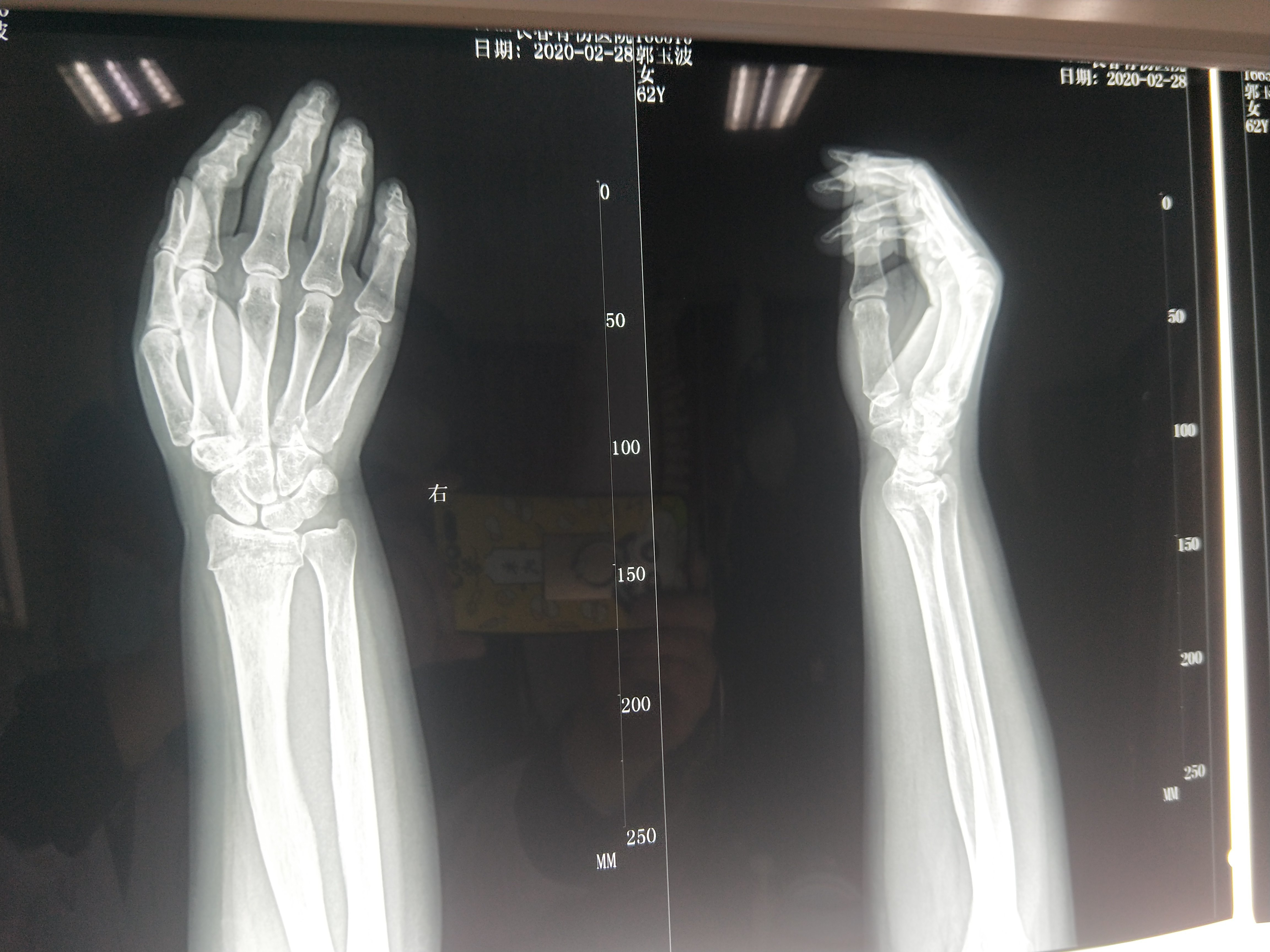 左桡骨远端骨折位置图图片