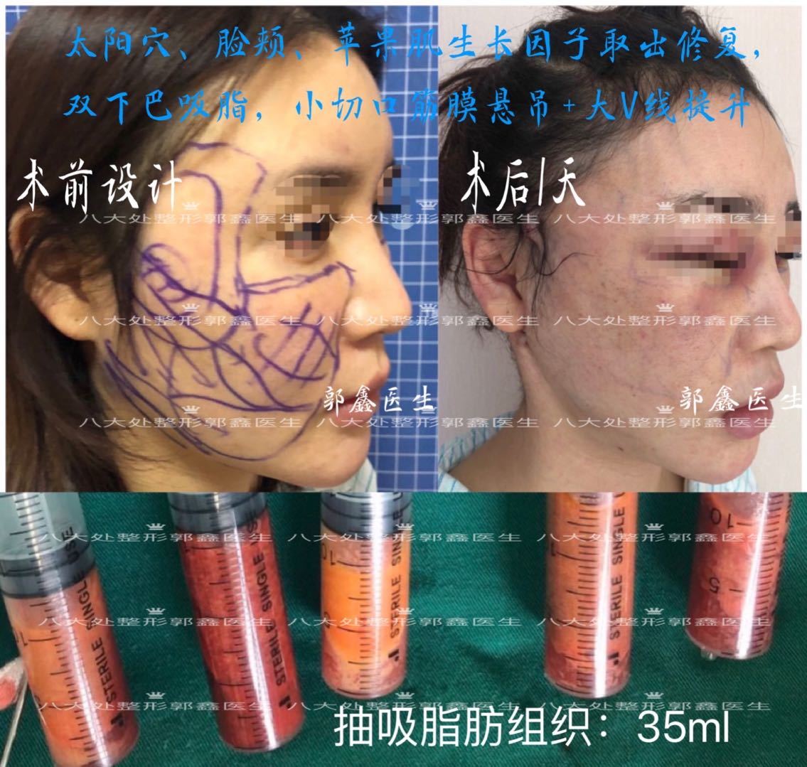 生長因子童顏針脂肪填充修復案例和簡介郭鑫醫生