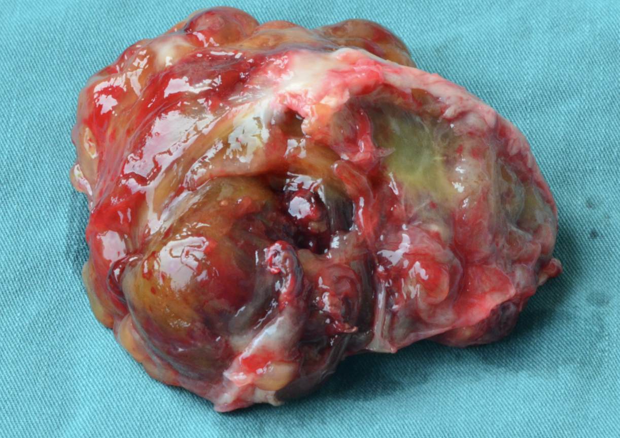 恶性肿瘤的样子图图片