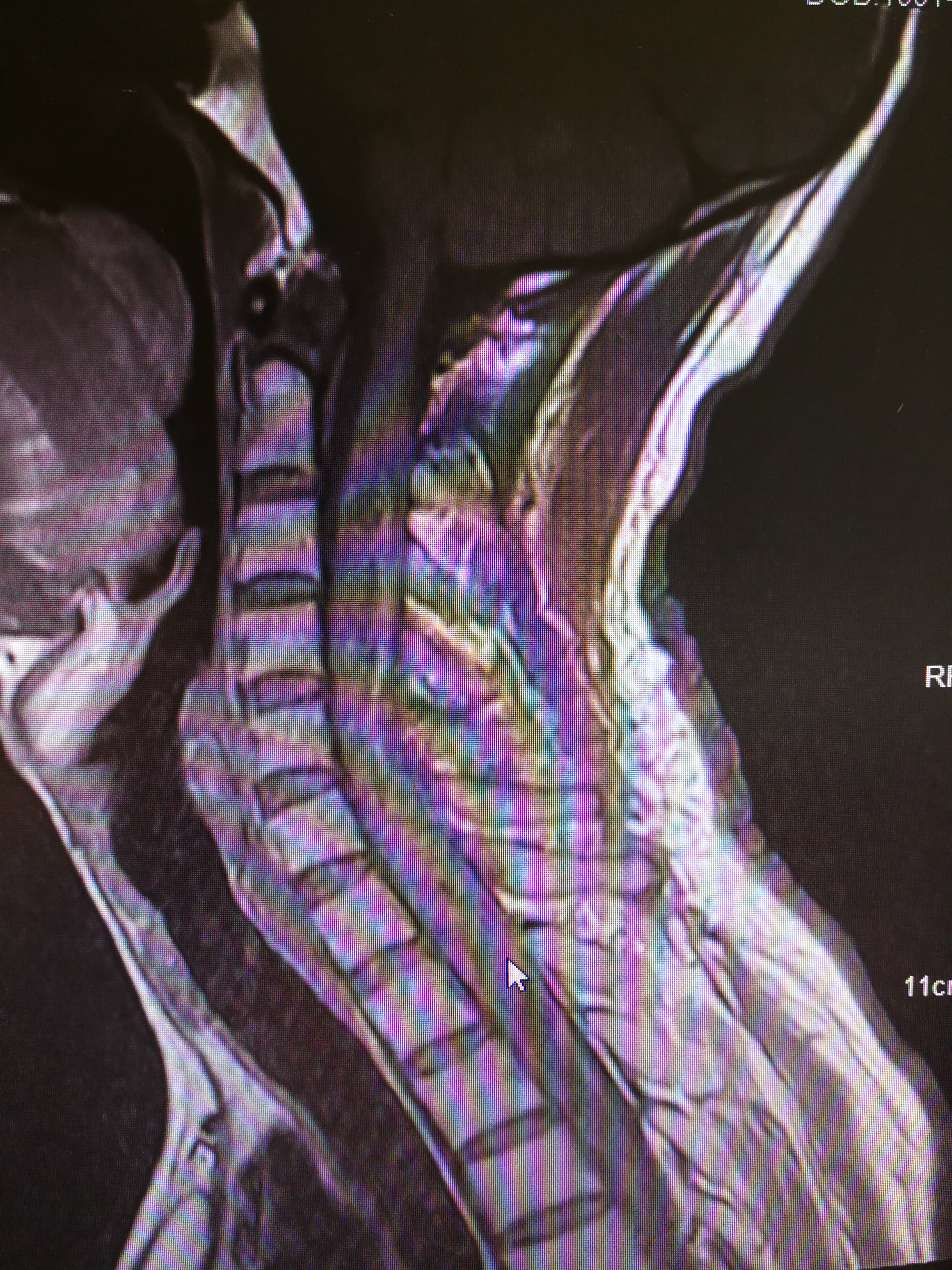 典型病例(三)脊膜瘤的手术通常得行全椎板开窗下进行,待肿瘤切除后