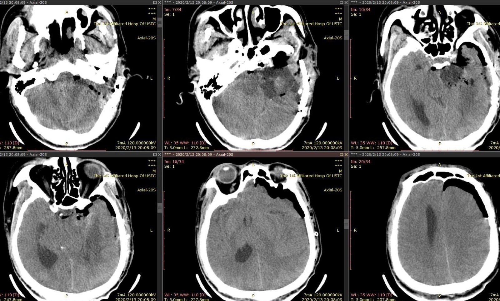 疫情下的巨大岩斜坡脑膜瘤-9.jpg