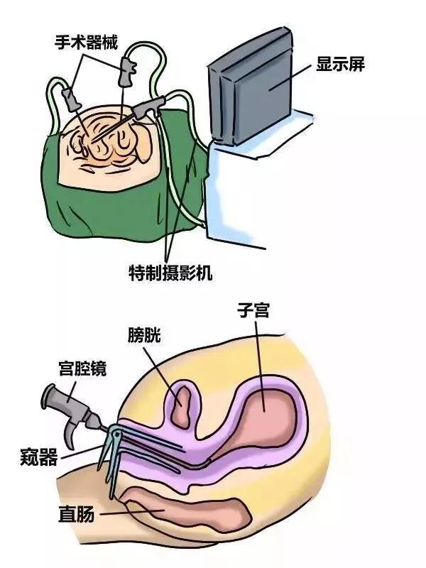 宫腔镜宣传美篇图片