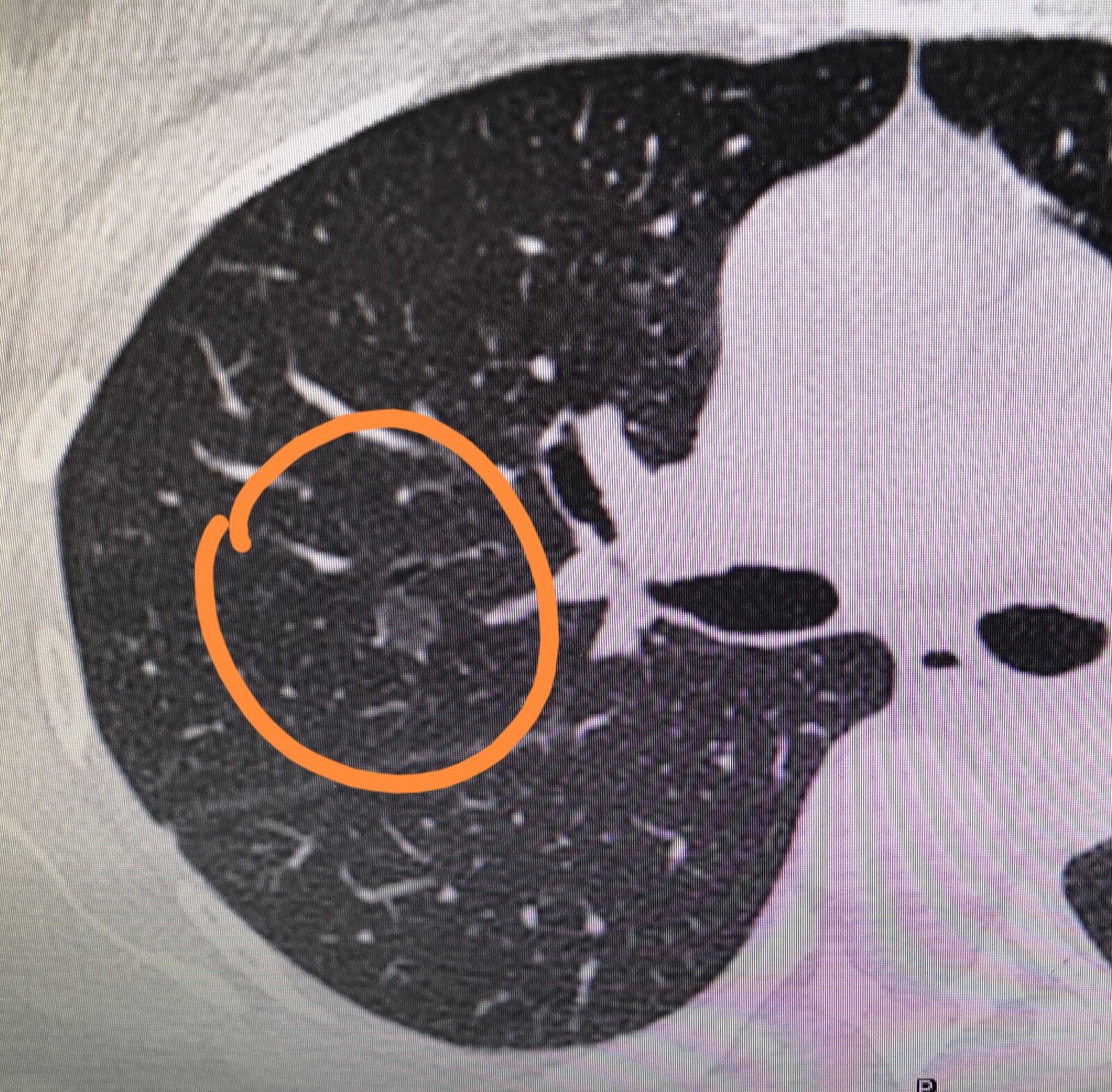 是不是一发现自己肺上长了一个结节就要马上手术切掉