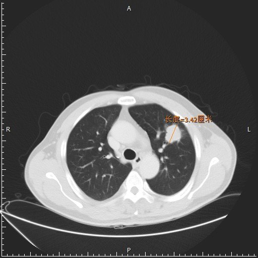 因為咳嗽到醫院就診,胸片上我們能看到左側肺部靠近肺門處一個大約3-4